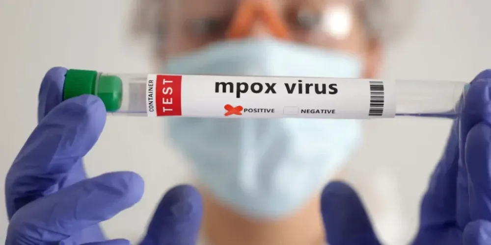 Brasil contabiliza 1,5 mil casos de mpox em 2024