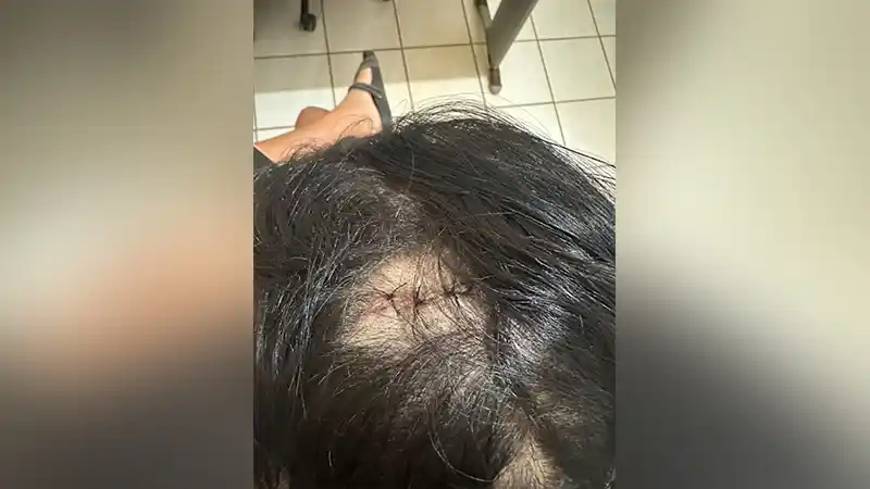 Indígena aplica golpe de facão na cabeça de técnica de enfermagem