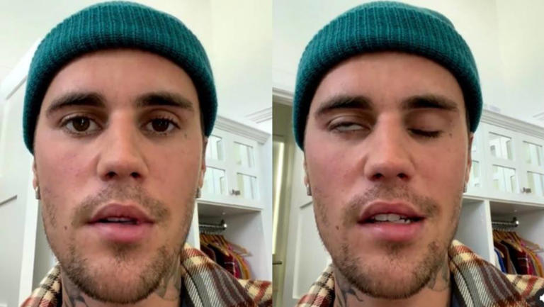 Justin Bieber aparece com metade do rosto paralisado e diz que tem síndrome de Ramsay Hunt
