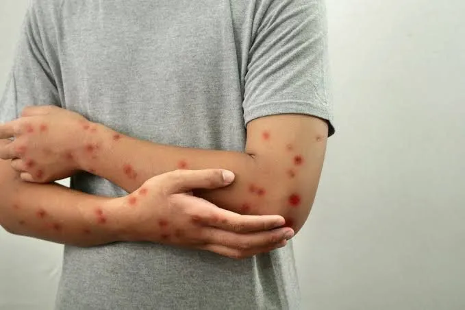 Secretaria de Saúde reforça orientações sobre a prevenção ao Mpox em Canaã dos Carajás