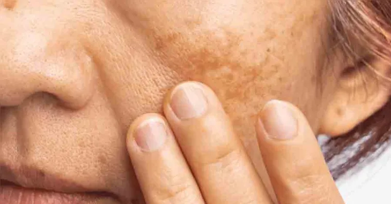Melasma: confira os cuidados essenciais para controlar as manchas
