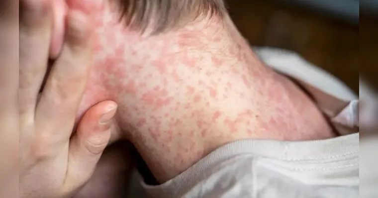 Nova York decreta estado de emergência por surto de sarampo